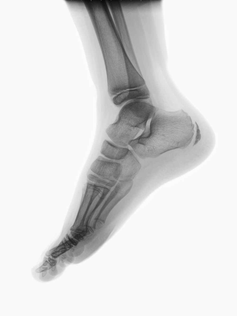 Can You Break an Ankle Without Realizing It?: Arlington/Mansfield Foot &  Ankle Centers: Podiatrists