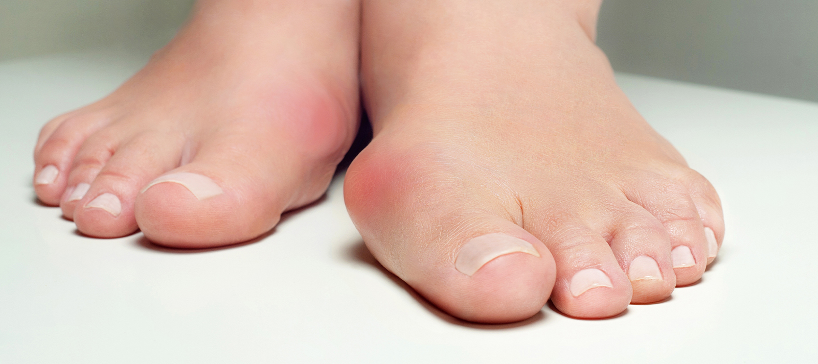 Balance Foot & Ankle - Bunions