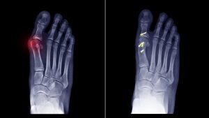 Balance - Foot & Ankle - Bunion
