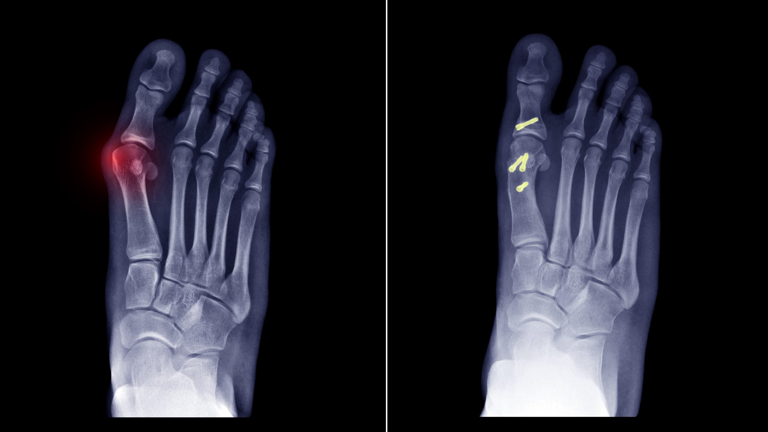 Balance - Foot & Ankle - Bunion
