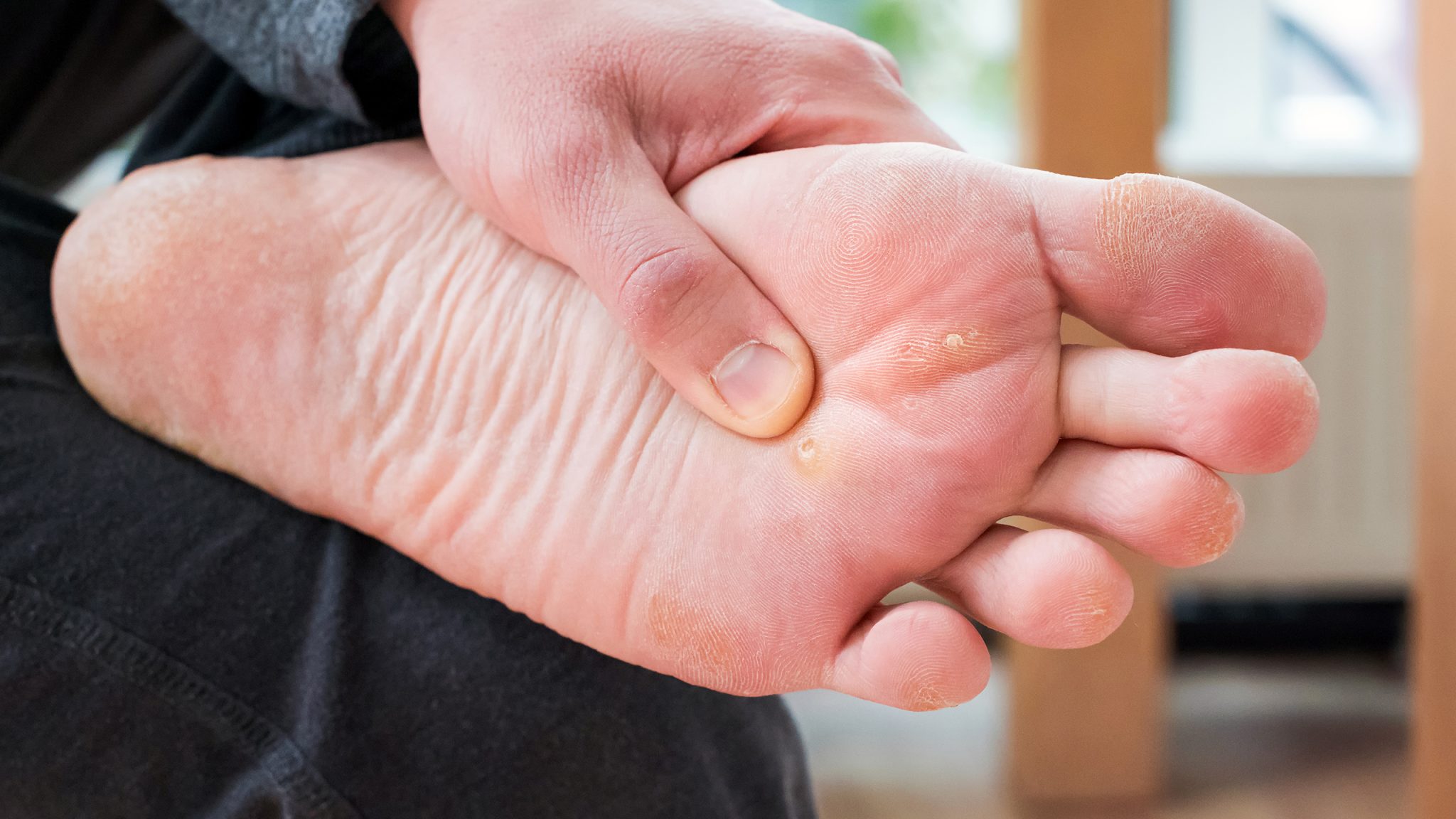 Callus 101 Causes, Prevention and Treatment Balance Foot & Ankle